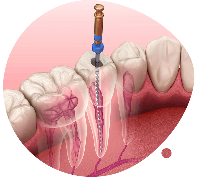 https://gelnicadent.sk/wp-content/uploads/2023/11/endodoncia.png