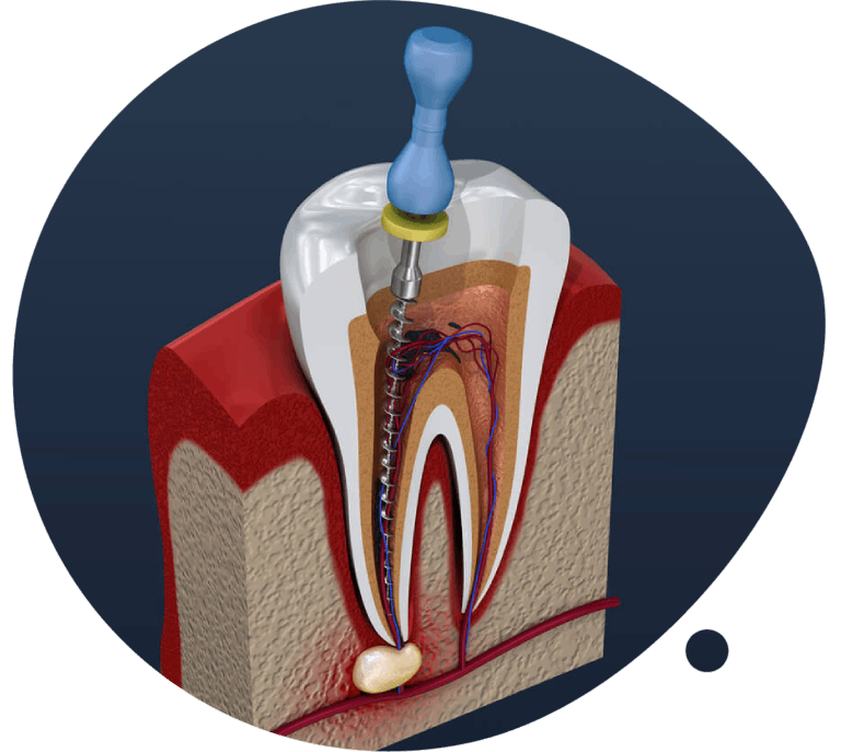 https://gelnicadent.sk/wp-content/uploads/2023/11/reendodoncia.png